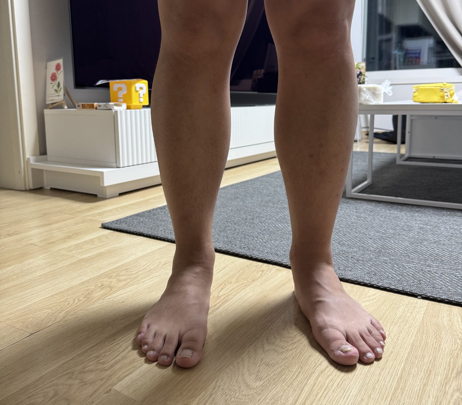 하지정맥류 치료받고 실비도 잘나왔어요